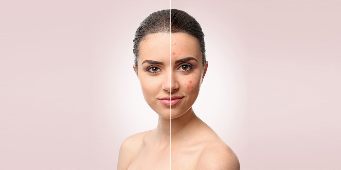 clear skin vs. acne