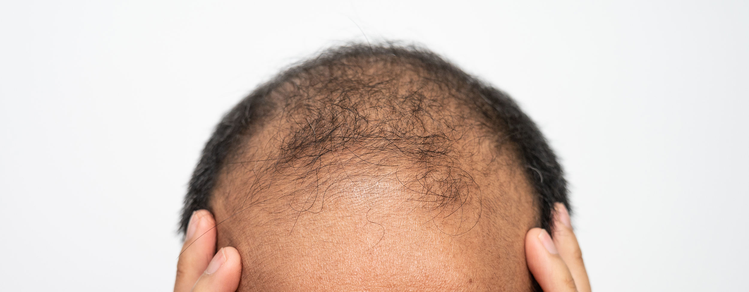 Adult man showing visible signs of hair loss